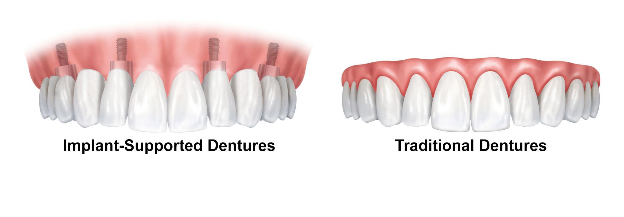 Illustration of implant-supported vs. traditional denture