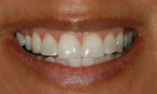 After teeth whitening