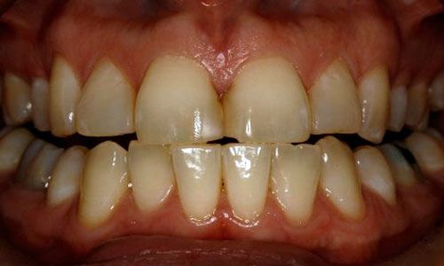 patient before teeth whitening