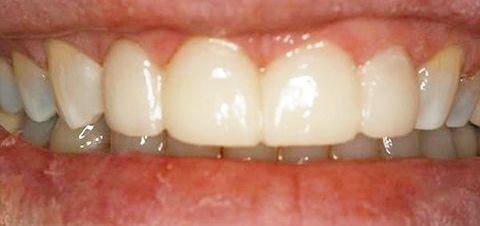 after whitening and bonding