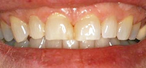 before whitening and bonding