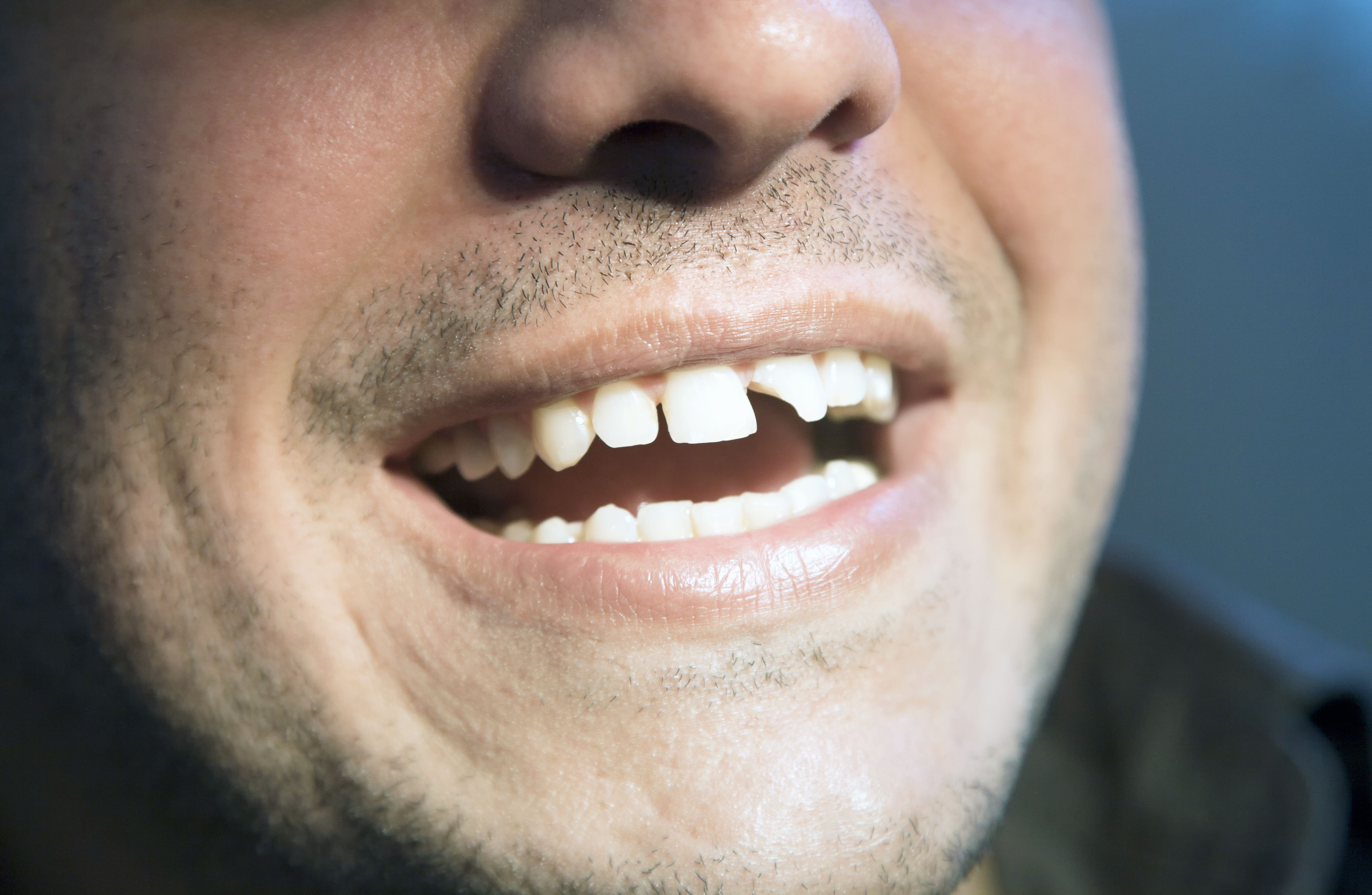 A man with a chipped front tooth